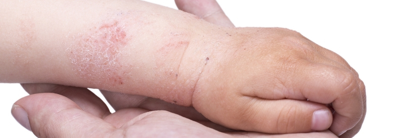 baby's hand with eczema from latex allergy foods 