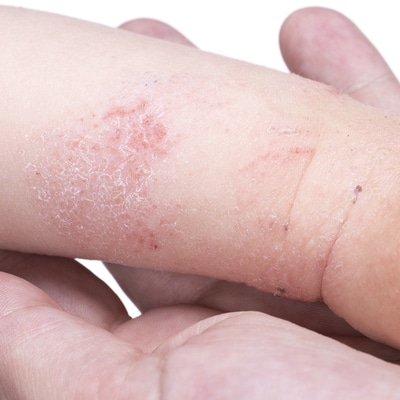 close up of eczema on childs hand