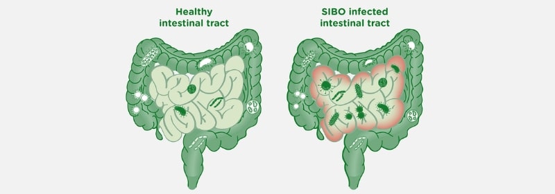 Rosacea and Small Intestinal Bacterial Overgrowth (SIBO)