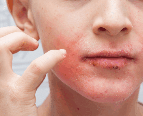 natural eczema relief for children