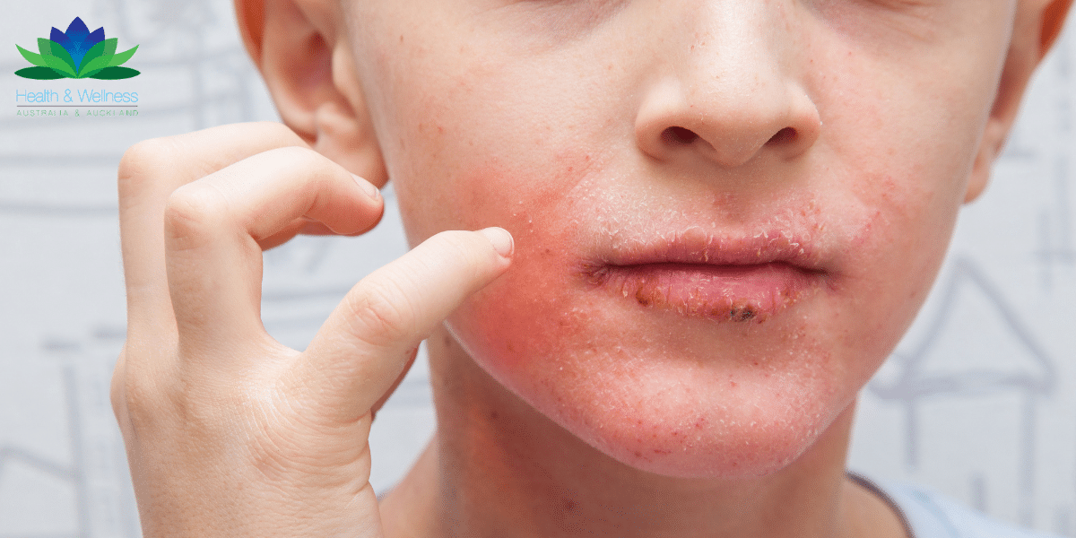 Natural Eczema Relief for Children - Natural Allergy Treatment